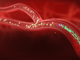Ραδιοεμβολισμός ήπατος με Yttrium-90 (SIRT)