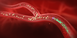 Ραδιοεμβολισμός ήπατος με Yttrium-90 (SIRT)