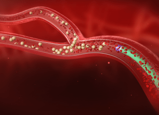 Ραδιοεμβολισμός ήπατος με Yttrium-90 (SIRT)