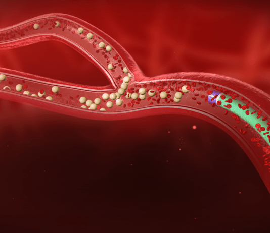 Ραδιοεμβολισμός ήπατος με Yttrium-90 (SIRT)