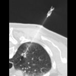 needle_biopsy thorax