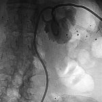 nefrostomy