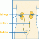 nefrostomy