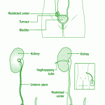 nefrostomy1