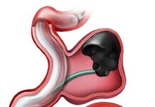 Ανεύρυσμα έσω λαγονίου αρτηρίας