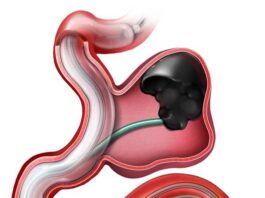 Ανεύρυσμα έσω λαγονίου αρτηρίας