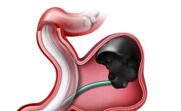 Ανεύρυσμα έσω λαγονίου αρτηρίας