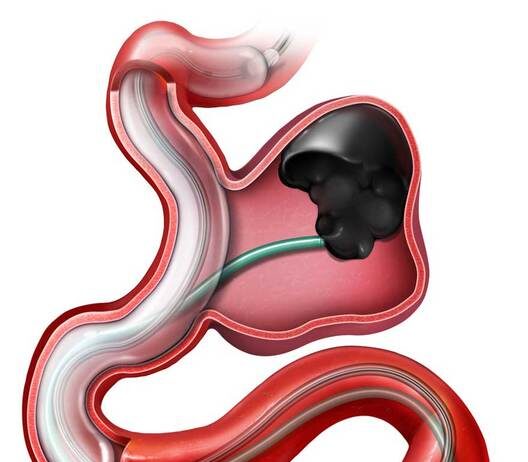 Ανεύρυσμα έσω λαγονίου αρτηρίας