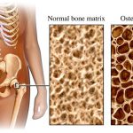 osteoporosis