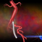 stent