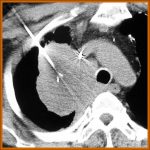 rf lung