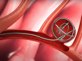 Εμβολισμός αγγείου – ανευρύσματος