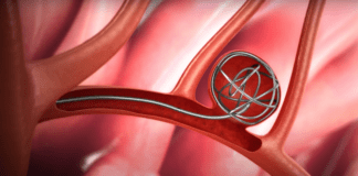 Εμβολισμός αγγείου – ανευρύσματος