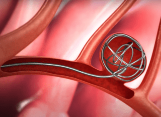 Εμβολισμός αγγείου – ανευρύσματος