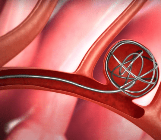 Εμβολισμός αγγείου – ανευρύσματος