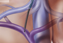 Διασφαγιτιδική ενδοηπατική πυλαιοσυστηματική αναστόμωση (TIPS)