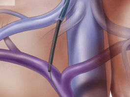 Διασφαγιτιδική ενδοηπατική πυλαιοσυστηματική αναστόμωση (TIPS)