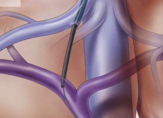 Διασφαγιτιδική ενδοηπατική πυλαιοσυστηματική αναστόμωση (TIPS)