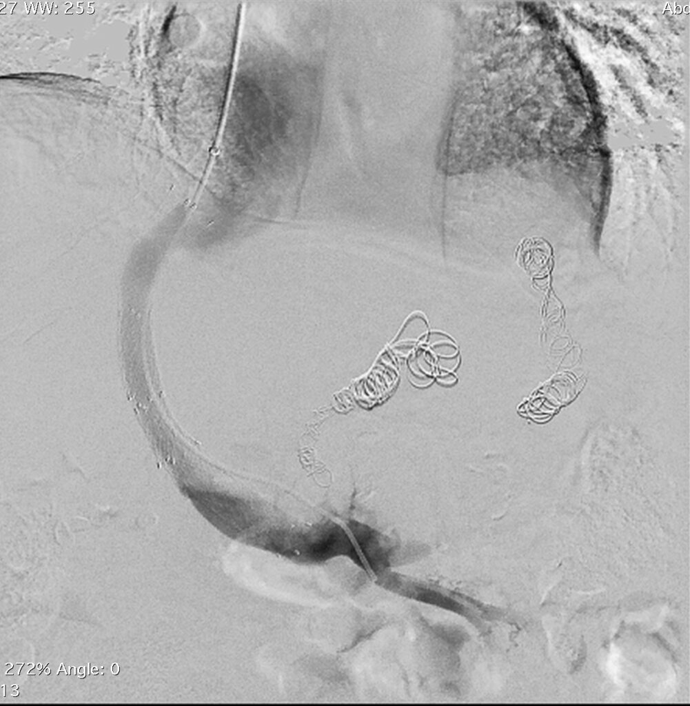 Tips Dips Radiology Διασφαγιτιδική ενδοηπατική πυλαιοσυστηματική αναστόμωση (TIPS ...