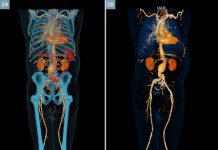 Αγγειογραφία