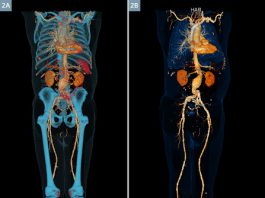 Αγγειογραφία