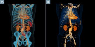 Αγγειογραφία