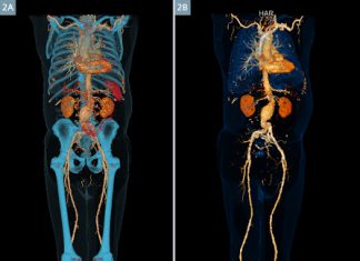 Αγγειογραφία