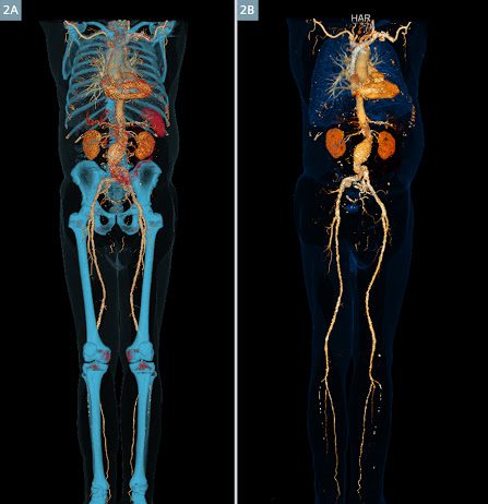 Αγγειογραφία