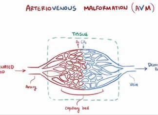 Αρτηριοφλεβώδης επικοινωνία πνεύμονα