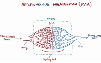 Αρτηριοφλεβώδης επικοινωνία πνεύμονα