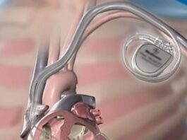 Αφαίρεση ξένου σώματος (ηλεκτρόδιο βηματοδότη)