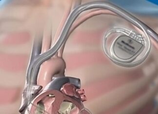 Αφαίρεση ξένου σώματος (ηλεκτρόδιο βηματοδότη)