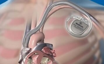 Αφαίρεση ξένου σώματος (ηλεκτρόδιο βηματοδότη)