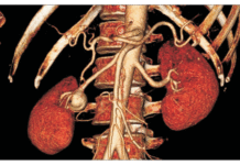 Ανεύρυσμα νεφρικής αρτηρίας