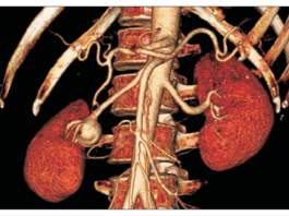 Ανεύρυσμα νεφρικής αρτηρίας