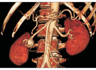 Ανεύρυσμα νεφρικής αρτηρίας
