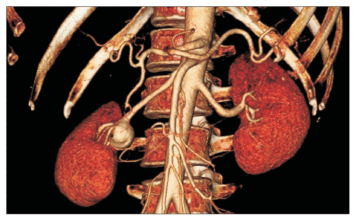 Ανεύρυσμα νεφρικής αρτηρίας