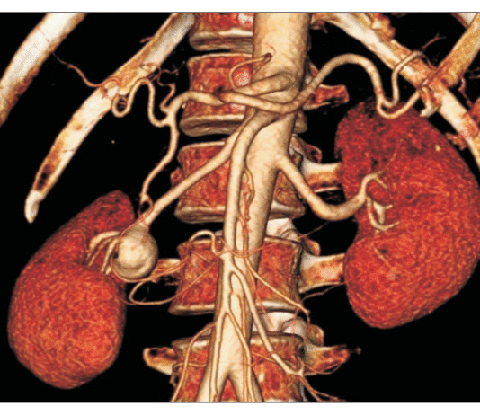 Ανεύρυσμα νεφρικής αρτηρίας
